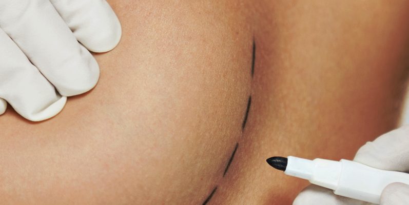 Breast Reduction Surgery