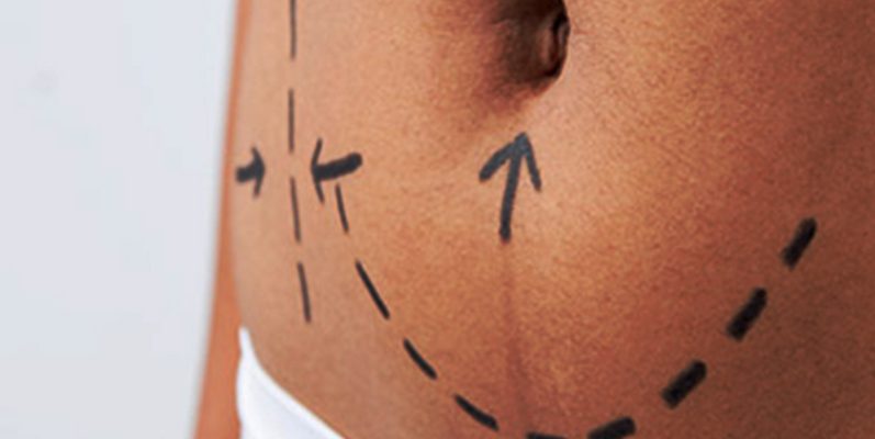 Mini-Tummy Tuck Surgery Weight Loss