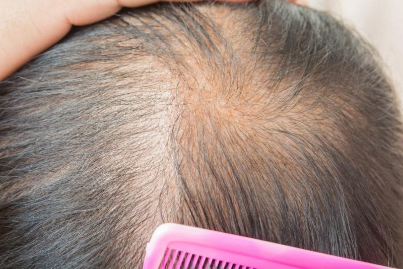 PRP therapy for hair loss can be used to fight thinning hair