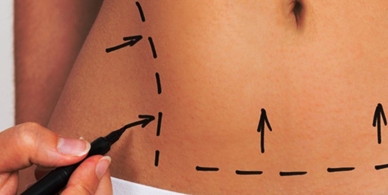 Tummy Tuck Surgery Weight Loss