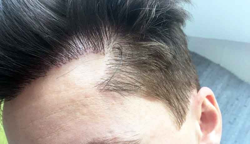 How Long Does A Hair Transplant Last? - Better Body Surgery