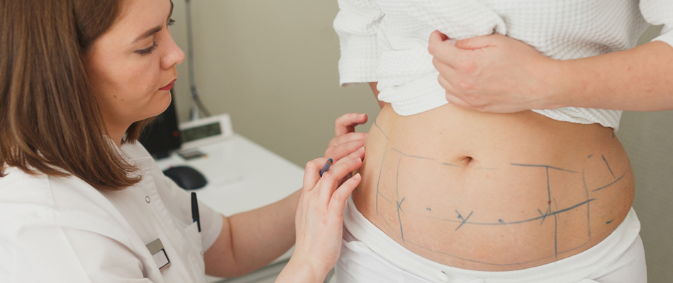 Although liposuction surgery is often considered to be a form of weight loss surgery, it's technically not