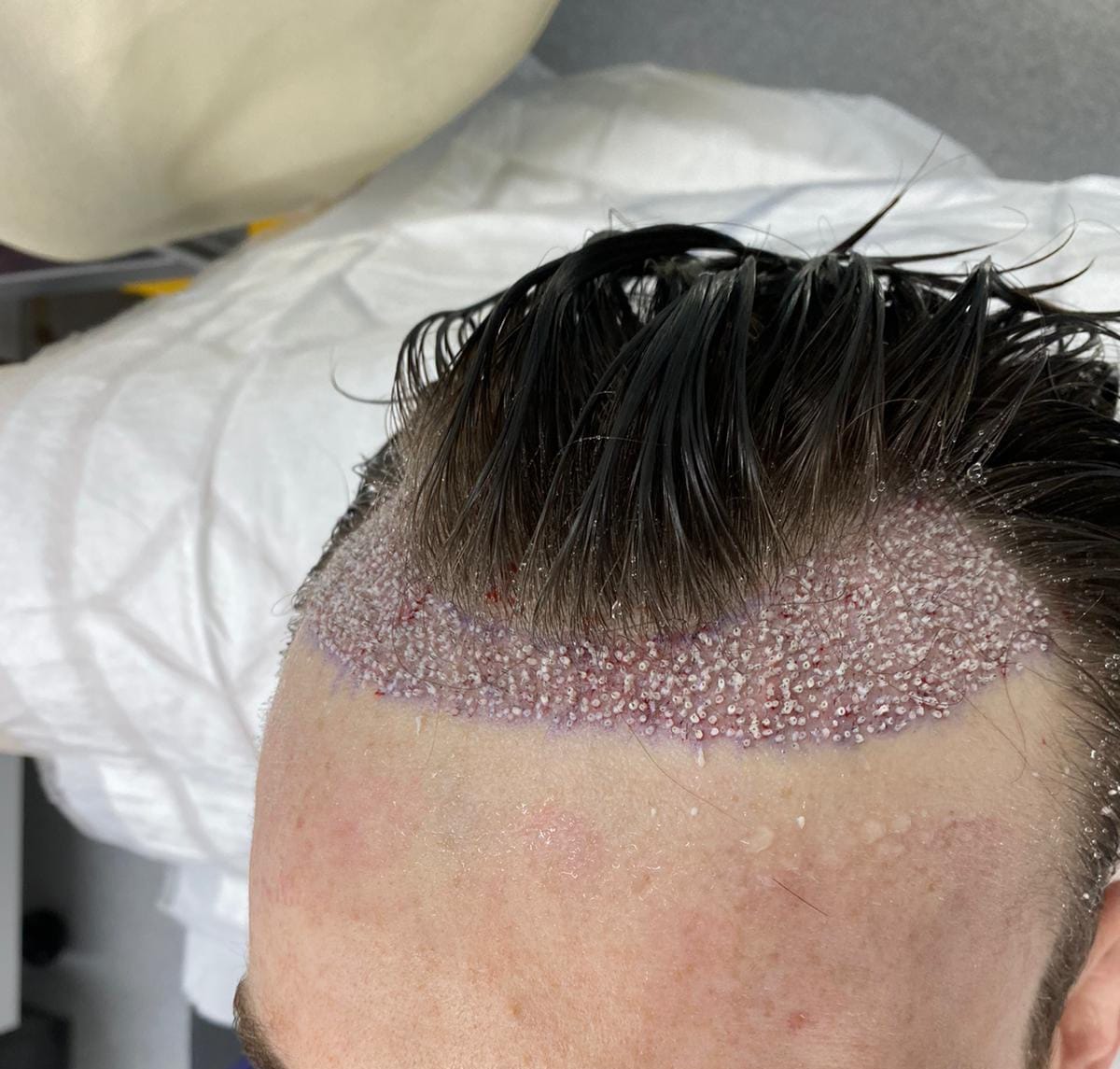 Immediate results to the hairline following a hair transplant procedure
