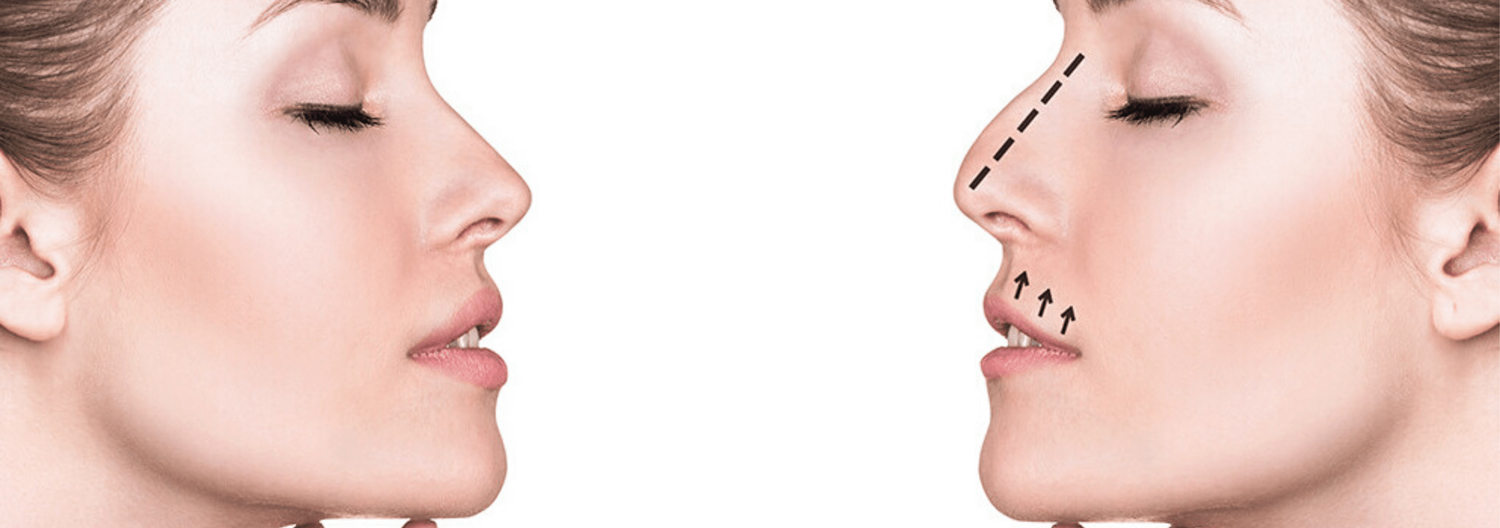 Undergoing a nose job surgery can give a hugely different appearance to your face