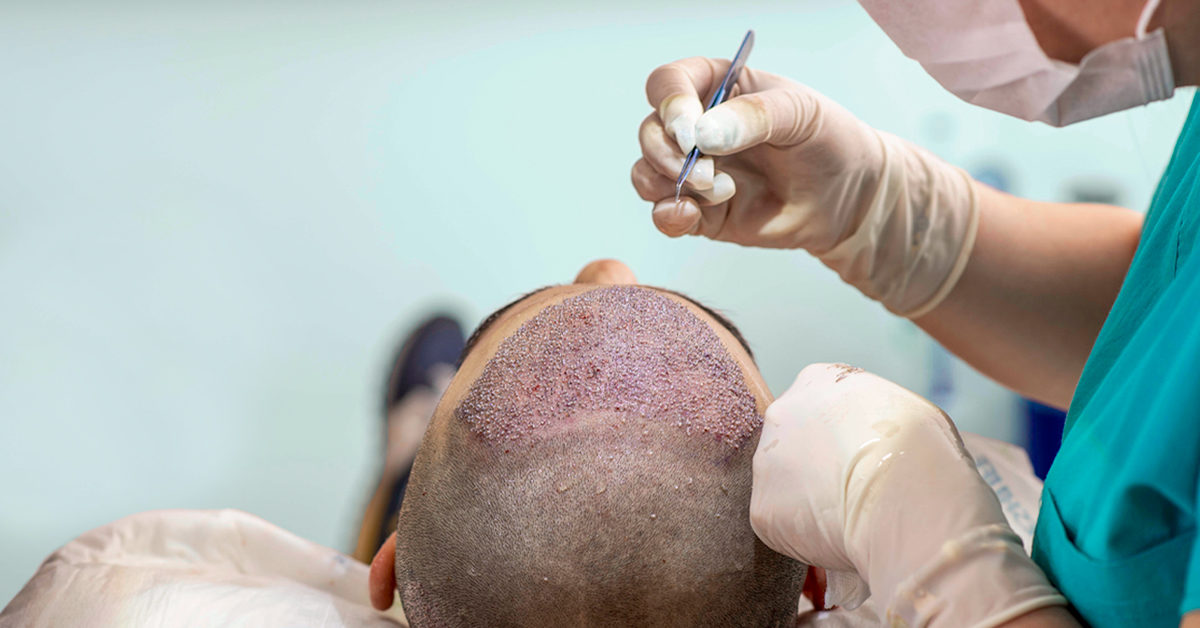 Hair transplant surgery, while it looks scary, is actually a much nicer procedure than you could imagine