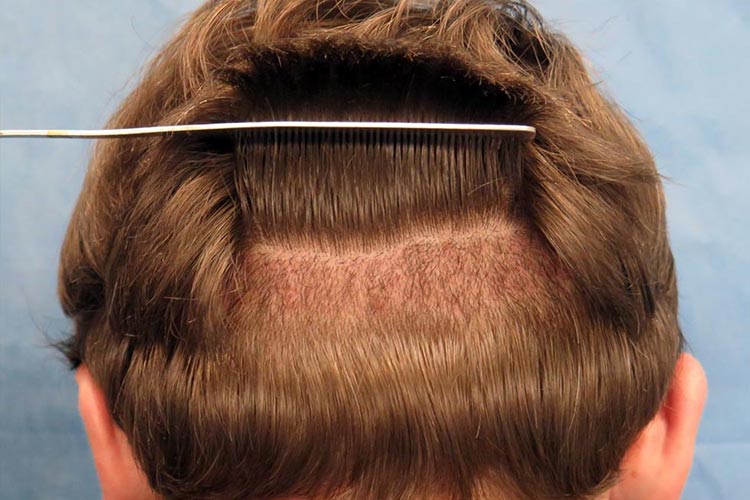 The donor area of the scalp plays a hugely important role in the success of the hair transplant