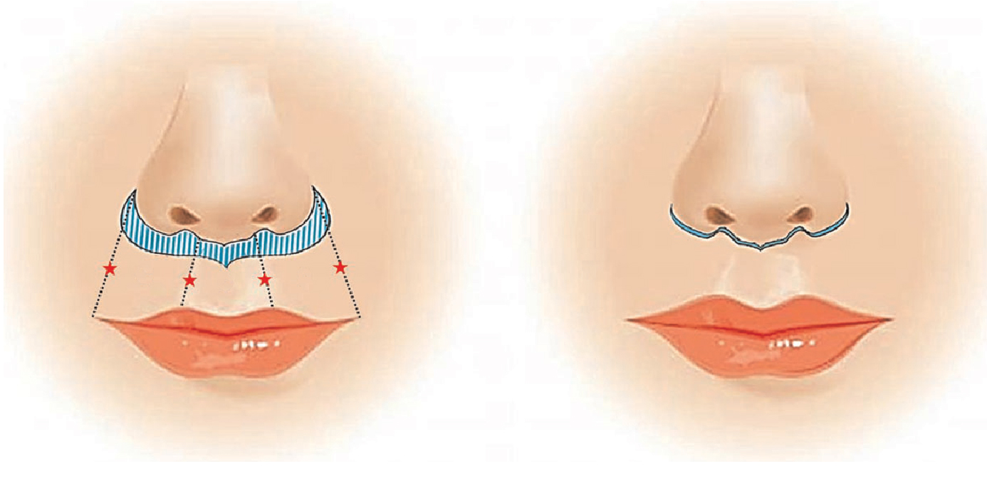 Undergoing buccal fat removal