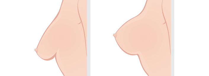 Breast uplift surgery is performed to refresh the appearance of the breasts