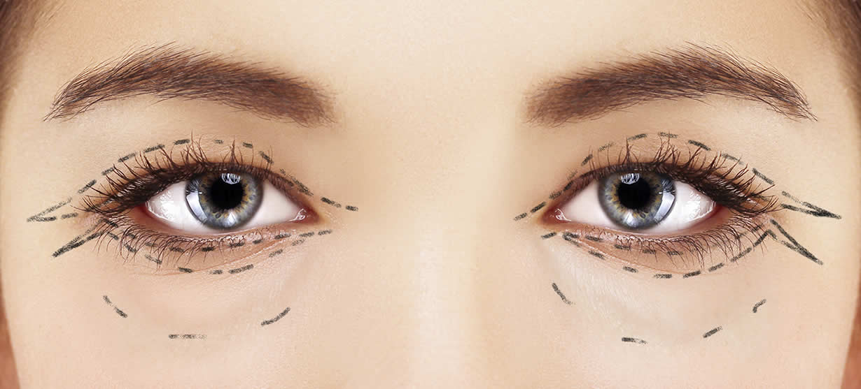 Blepharoplasty surgery is performed to remove excess skin from the eyelids