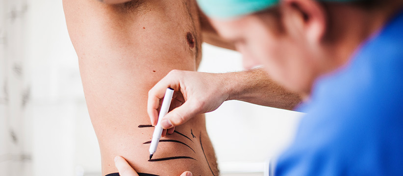 Liposuction fat removal