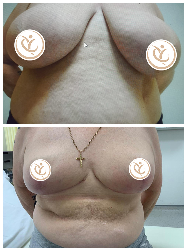 Breast reduction surgery